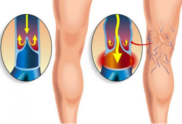 Йога при варикозе: комплекс упражнений, асаны
