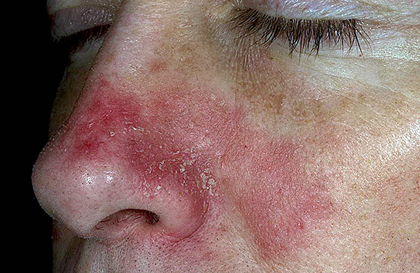 К чему приводит недостаток витамина а