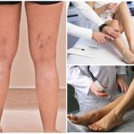 Какой врач лечит варикоз: флеболог, хирург, ангиолог, терапевт