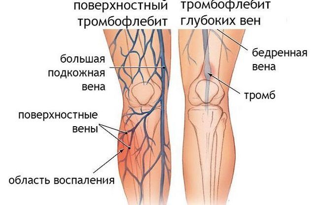 Какой врач лечит варикоз: флеболог, хирург, ангиолог, терапевт