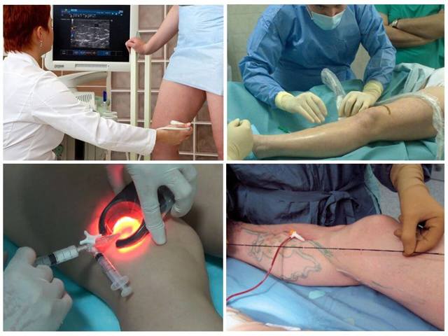 Какой врач лечит варикоз: флеболог, хирург, ангиолог, терапевт