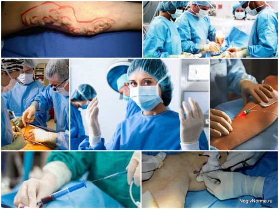 Какой врач лечит варикоз: флеболог, хирург, ангиолог, терапевт