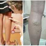 Какой врач лечит варикоз: флеболог, хирург, ангиолог, терапевт