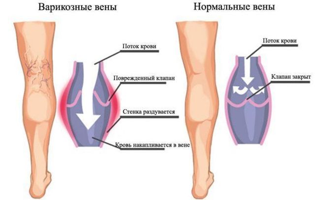 Какой врач лечит варикоз: флеболог, хирург, ангиолог, терапевт