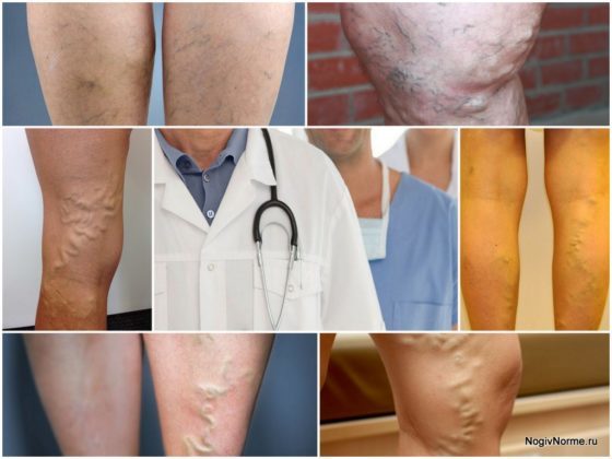 Какой врач лечит варикоз: флеболог, хирург, ангиолог, терапевт