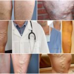 Какой врач лечит варикоз: флеболог, хирург, ангиолог, терапевт