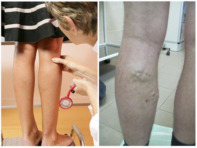 Какой врач лечит варикоз: флеболог, хирург, ангиолог, терапевт