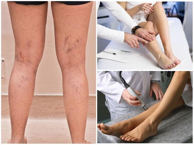 Какой врач лечит варикоз: флеболог, хирург, ангиолог, терапевт
