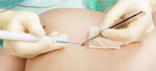 Капиллярная гемангиома у взрослых и новорожденных детей: фото, лечение, виды