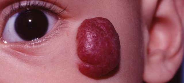 Капиллярная гемангиома у взрослых и новорожденных детей: фото, лечение, виды