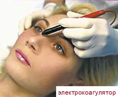 Капиллярная гемангиома у взрослых и новорожденных детей: фото, лечение, виды