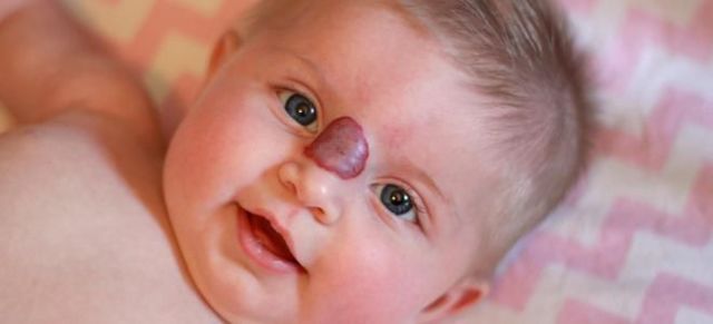 Капиллярная гемангиома у взрослых и новорожденных детей: фото, лечение, виды