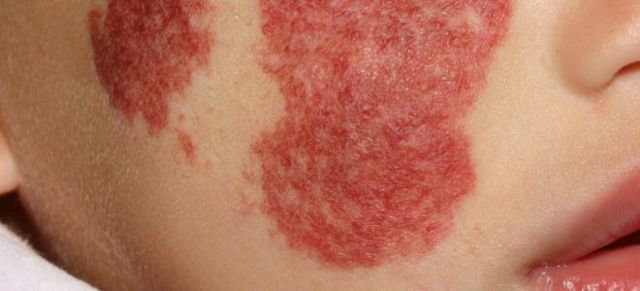 Капиллярная гемангиома у взрослых и новорожденных детей: фото, лечение, виды