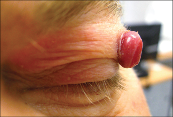 Капиллярная гемангиома у взрослых и новорожденных детей: фото, лечение, виды