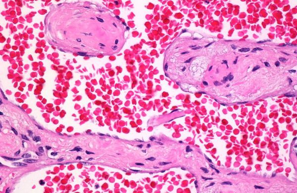 Кавернозная гемангиома (печени, позвоночника, кожи): симптомы, лечение (нейрохирургия)