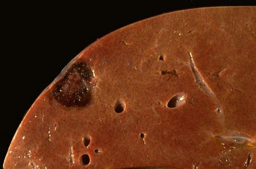 Кавернозная гемангиома (печени, позвоночника, кожи): симптомы, лечение (нейрохирургия)