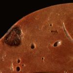 Кавернозная гемангиома (печени, позвоночника, кожи): симптомы, лечение (нейрохирургия)