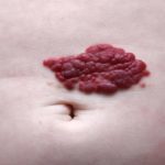 Кавернозная гемангиома (печени, позвоночника, кожи): симптомы, лечение (нейрохирургия)