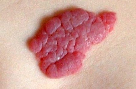 Кавернозная гемангиома (печени, позвоночника, кожи): симптомы, лечение (нейрохирургия)