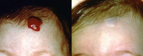 Кавернозная гемангиома (печени, позвоночника, кожи): симптомы, лечение (нейрохирургия)