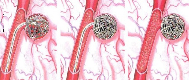 Кавернозная гемангиома (печени, позвоночника, кожи): симптомы, лечение (нейрохирургия)