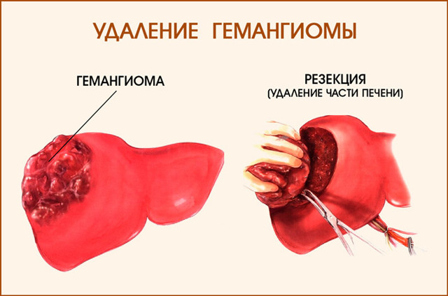 Кавернозная гемангиома (печени, позвоночника, кожи): симптомы, лечение (нейрохирургия)