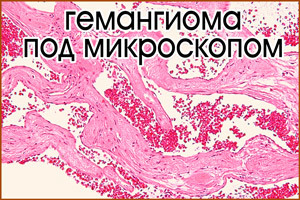 Кавернозная гемангиома (печени, позвоночника, кожи): симптомы, лечение (нейрохирургия)