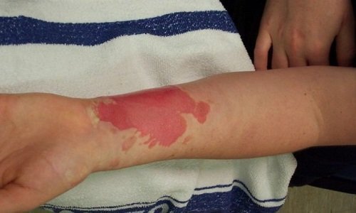 Компресс димексид и новокаин – можно ли принимать одновременно (совместимость)