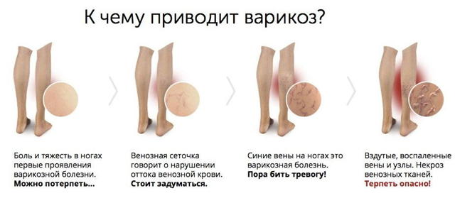 Крем для ног от варикоза при беременности: гепариновая мазь, крем мама комфорт, лиотон гель, гепатромбин, троксерутин (мази в домашних условиях)