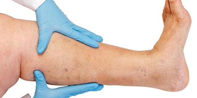 Крем для ног от варикоза при беременности: гепариновая мазь, крем мама комфорт, лиотон гель, гепатромбин, троксерутин (мази в домашних условиях)