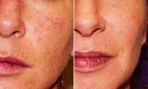 Крем от купероза на лице: аптечные, народные, для профилактики, отзывы