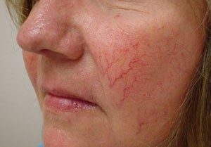 Крем от купероза на лице: аптечные, народные, для профилактики, отзывы