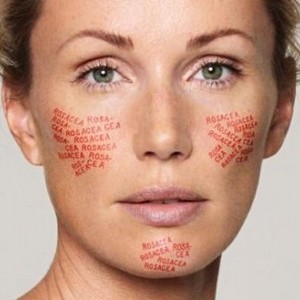 Крем от розацеа