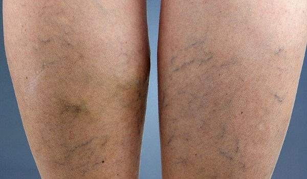 Крем софья при варикозе – инструкция по применению, отзывы, аналоги, форма выпуска, побочные действия, противопоказания, цена