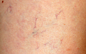 Крем софья при варикозе – инструкция по применению, отзывы, аналоги, форма выпуска, побочные действия, противопоказания, цена