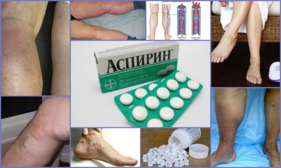 Кроверазжижающие препараты при варикозе и тромбозе нового поколения без аспирина: как принимать, показания, противопоказания
