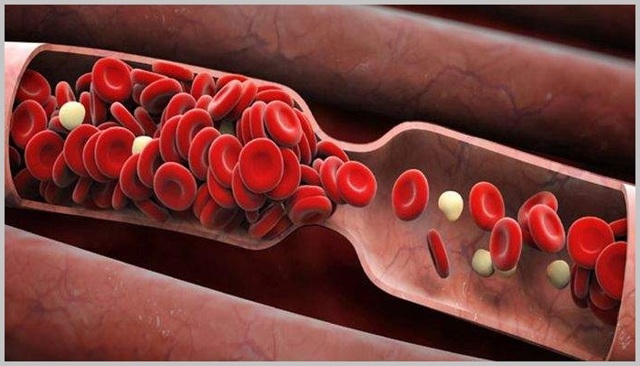 Кроверазжижающие препараты при варикозе и тромбозе нового поколения без аспирина: как принимать, показания, противопоказания