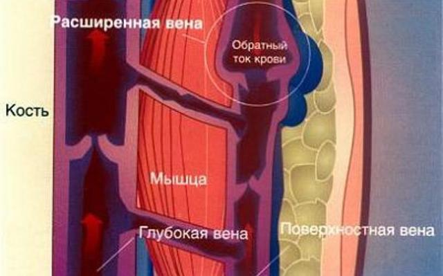 Кроверазжижающие препараты при варикозе и тромбозе нового поколения без аспирина: как принимать, показания, противопоказания