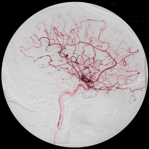 Купероз на лице: лечение (препараты), причины, симптомы