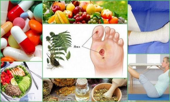 Лечение трофических язв в домашних условиях