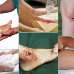 Лечение трофических язв в домашних условиях