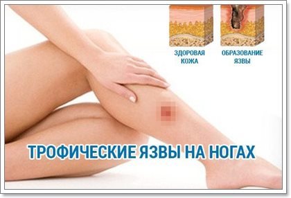 Лечение трофических язв в домашних условиях