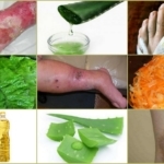 Лечение трофических язв в домашних условиях