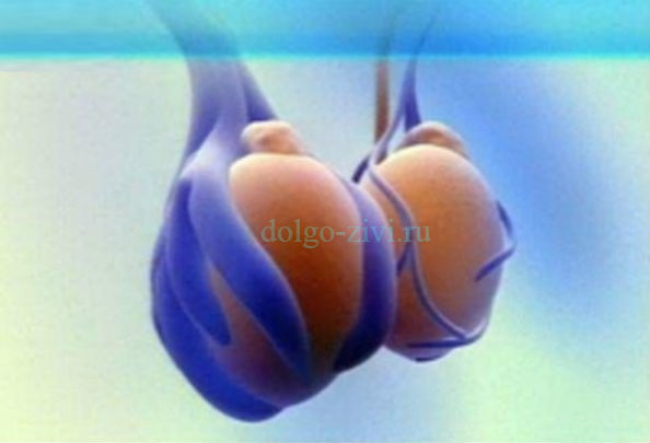 Лечение варикоцеле без операции: таблетки, народные средства, отзывы мужчин