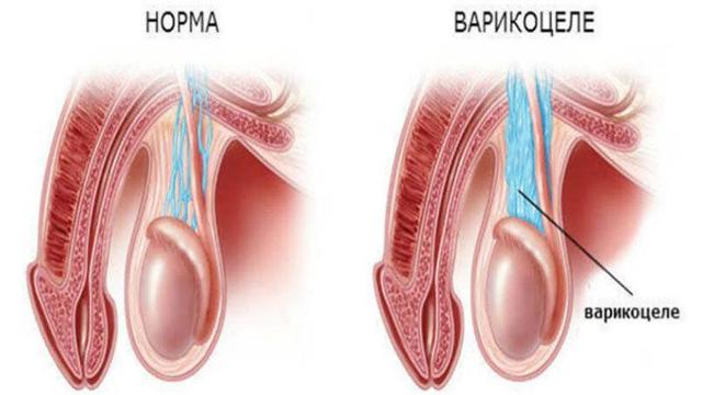Лечение варикоцеле без операции: таблетки, народные средства, отзывы мужчин