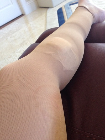 Лечение варикоза лазером: цена, отзывы, последствия