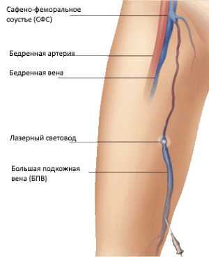 Лечение варикоза лазером: цена, отзывы, последствия