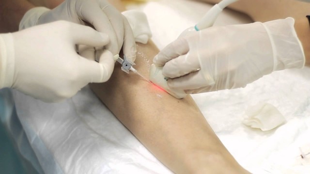 Лечение варикоза лазером: цена, отзывы, последствия