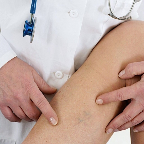 Лечение варикоза лазером: цена, отзывы, последствия