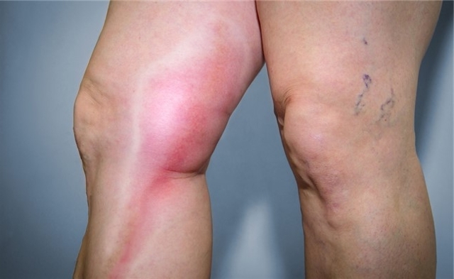 Лекарства от тромбофлебита нижних конечностей